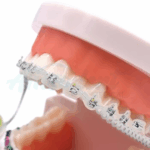 Cadeneta Elástica de brOrtodoncia Transparente